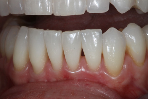 Before Bioclear Before Bioclear Downtown Seattle