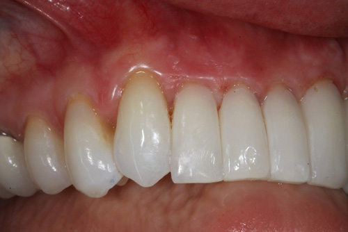 After Bioclear After Cosmetic Dentistry Downtown Seattle