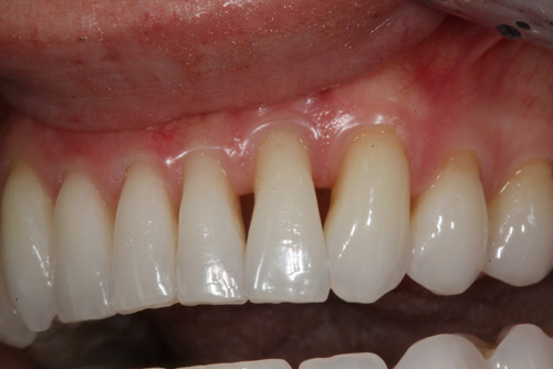 Cosmetic dentistry before Bioclear in Downtown Seattle