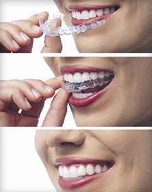 A young woman inserting a clear dental aligner.