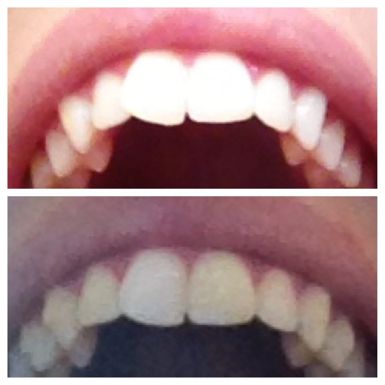 Crooked front tooth options