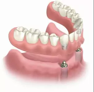 Denture Implants