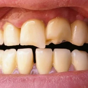 bulimia damage to teeth