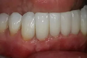 An after photo of teeth that have recieved Bioclear treatment.