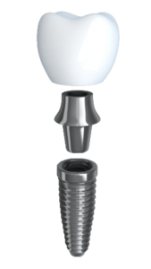 Graphic of a dental implant post and crown in Seattle