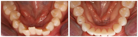 Invisalign clear braces in Seattle patient before and after photos