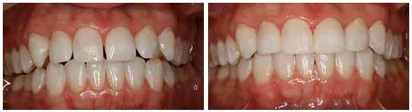 Dental bonding in Seattle patient before and after photos