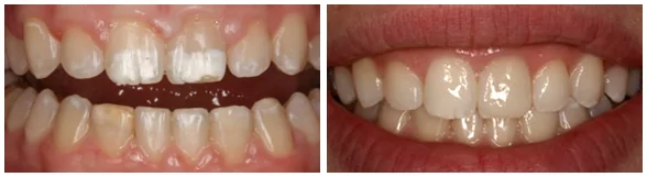 Dental bonding in Seattle patient before and after photos