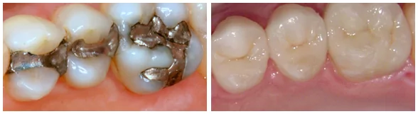 Dental fillings in Seattle patient before and after photos