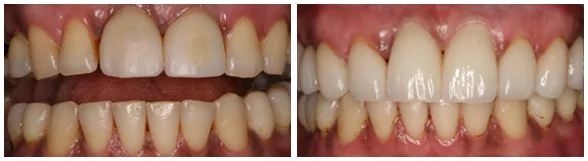 Dental implants in Seattle patient before and after photos