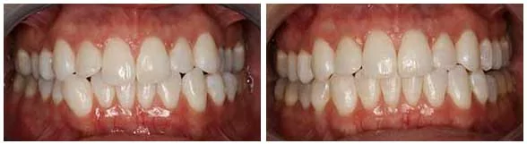 Invisalign clear braces in Seattle patient before and after photos