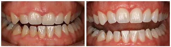 Laser gum contouring in Seattle patient before and after photos