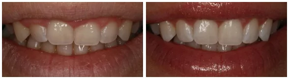 Laser gum contouring in Seattle patient before and after photos