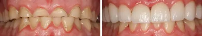 Porcelain veneers in Seattle patient before and after photos