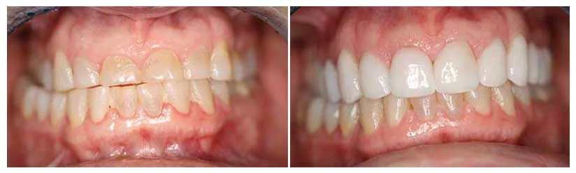 Porcelain veneers in Seattle patient before and after photos