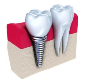 A graphic image of a dental implant installed in the jawbone.